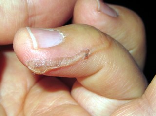 img_0117 - Glue burn - after cooling Glue burn - after cooling