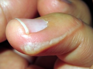 img_0150 - Glue burn - blister Glue burn - blister