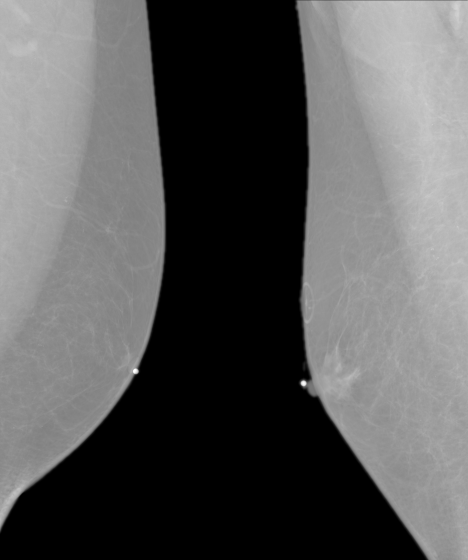 Left-right Mammogram