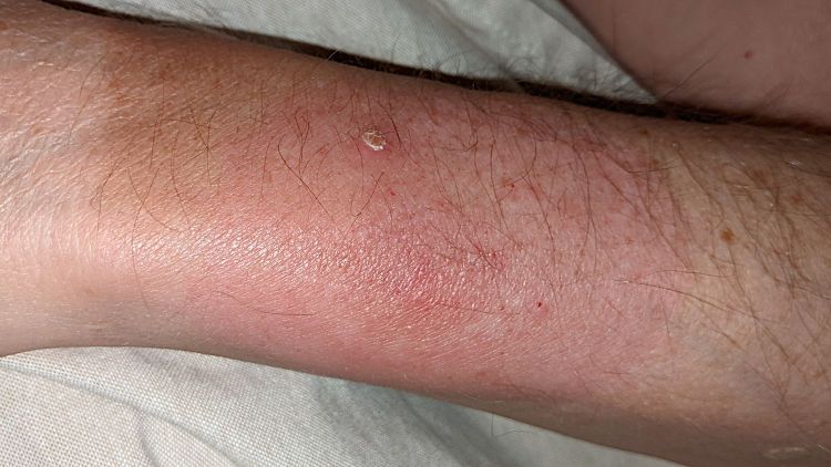 Lyme Disease - arm rash