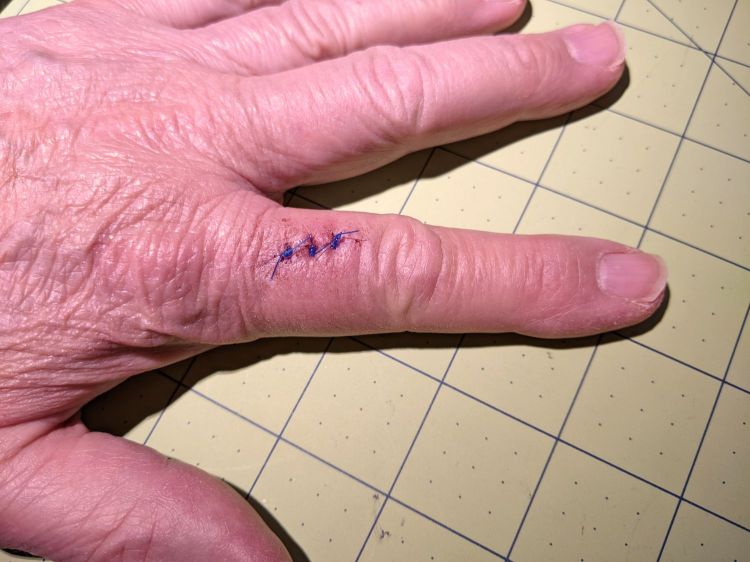 Lacerated Left Index Finger
