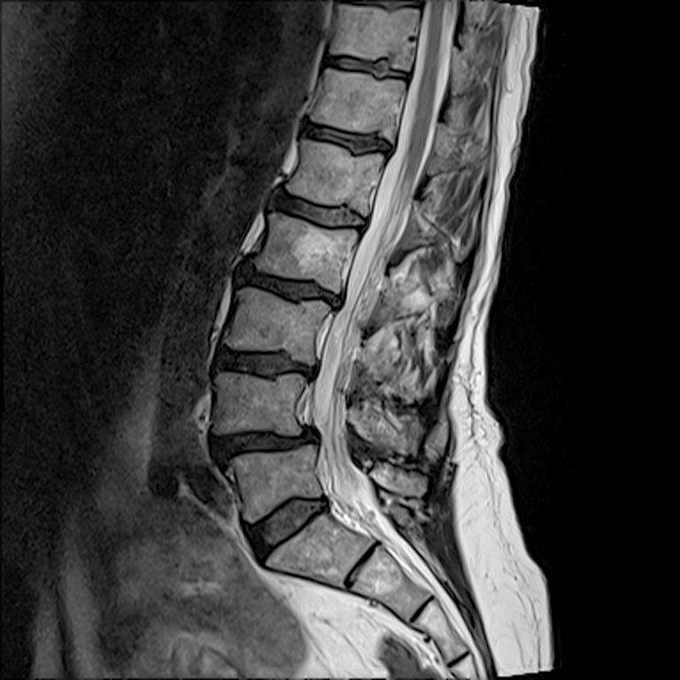 Spine - lateral T2 TSE SAG - 2025-02 - tweaked